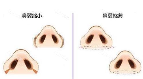 2025北京缩鼻翼手术多少钱？单纯切鼻翼/鼻翼缩小联合手术等价格明细一览