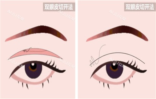 2025郴州双眼皮手术费用+靠谱医院推荐，唯美/维纳斯/曹家等双眼皮技术推荐