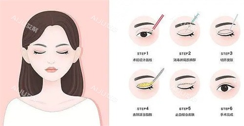 珠海做双眼皮多少钱？公布2025年珠海做埋线/切开/三点双眼皮等价格表
