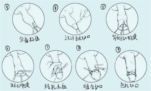 割包皮十个有九个后悔是真的吗?深度解析手术利弊、后遗症真相及2026避雷建议_艾聚网