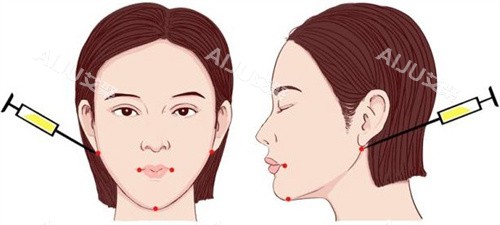 北京嘉美臻品整形贵吗？公开2026价目表：含玻尿酸、皮秒、仪器等项目报价