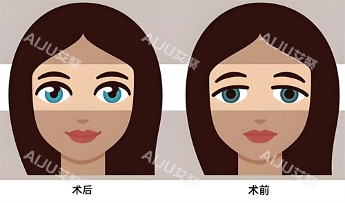 双眼皮术后术前对比动画图