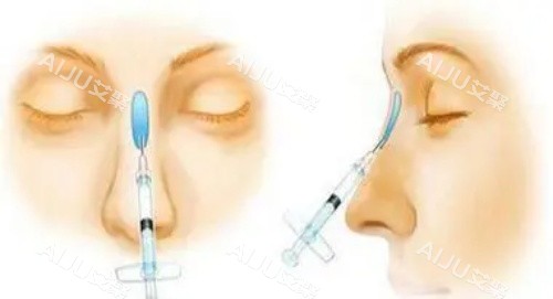 玻尿酸注射隆鼻示意图