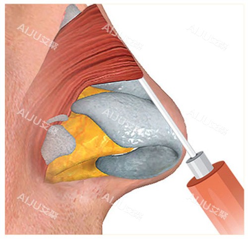 玻尿酸注射隆鼻过程图