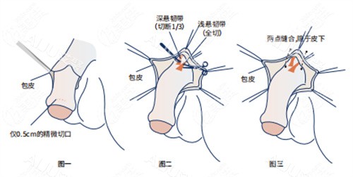 阴茎增长手术详细步骤演示动画图