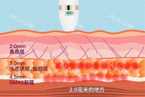 超声炮层次 超声炮层次