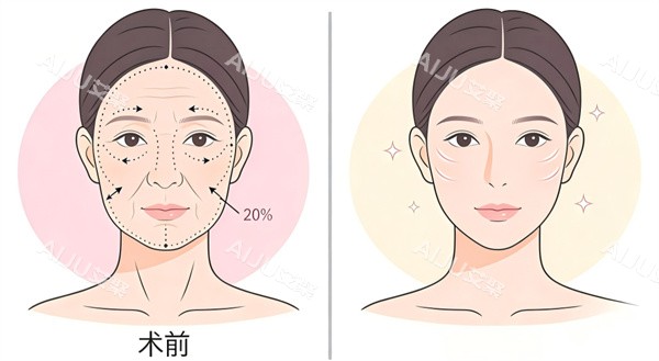 面部抗衰除皱手术前后不到