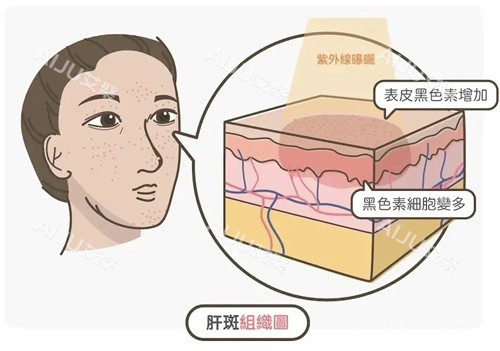 祛斑卡通图 祛斑卡通图