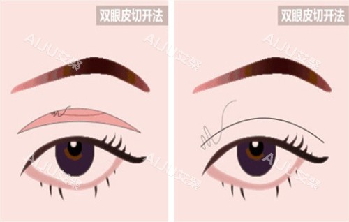 青岛割双眼皮哪家好？这几家医院患者评价不错，术后结果自然又好看！