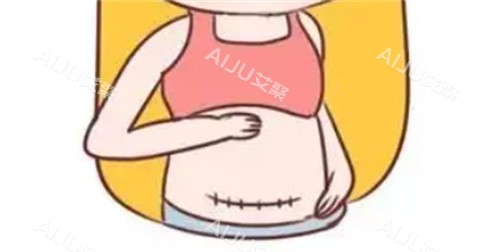 腹部疤痕