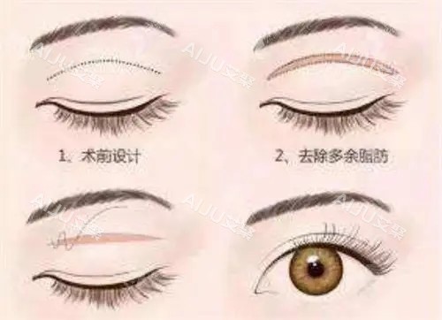 全切双眼皮卡通示意图