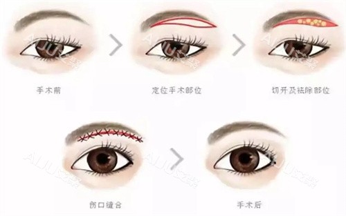 提眉手术步骤