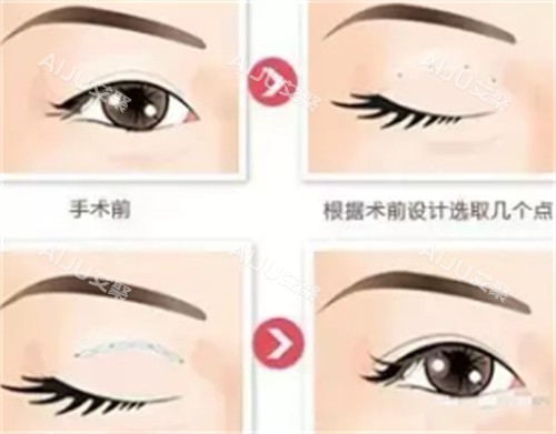 贝塞尔双眼皮手术过程图解