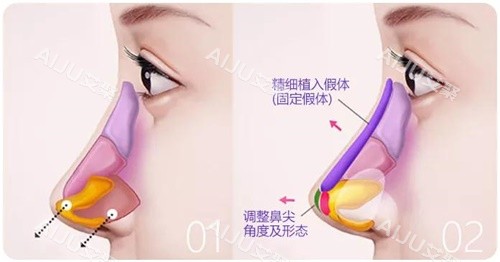 乌鲁木齐做鼻子多少钱？2026价格表深度解析，鼻综合整形30000起