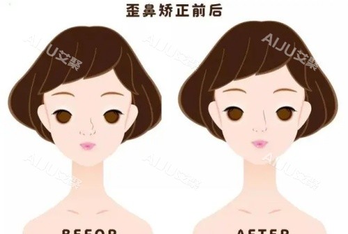 假体鼻子歪斜矫正前后示意图
