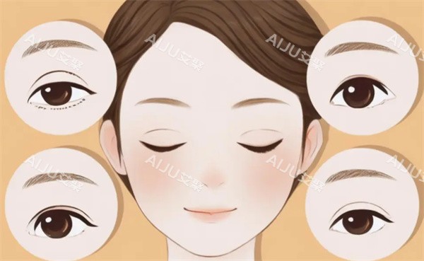双眼皮整形手术卡通图