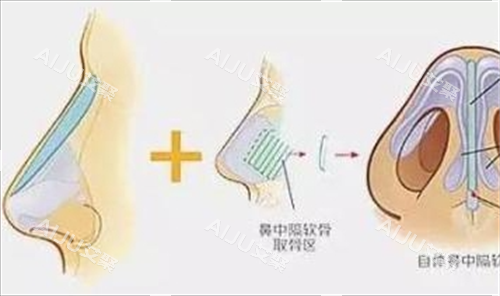 鼻小柱延长手术部位细节动画展示