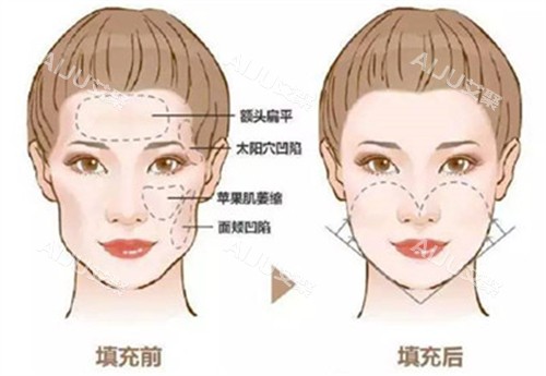 自体脂肪填充前后对比图