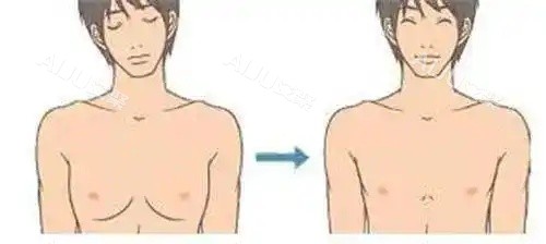 男性乳房发育吸脂后示意图