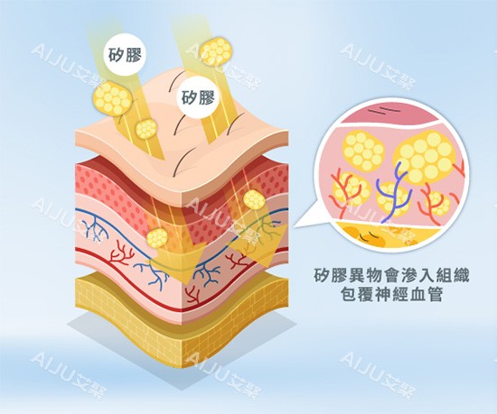 馒化针注射示意图