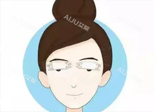 双眼皮术后