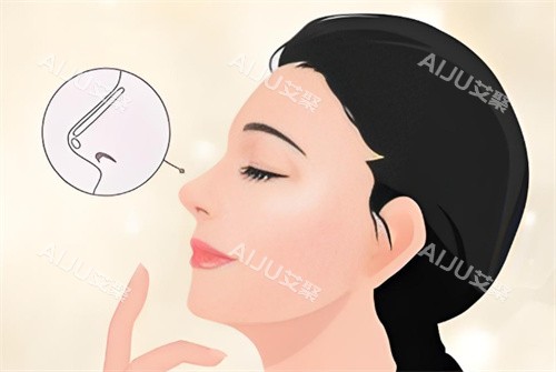 假体隆鼻卡通图