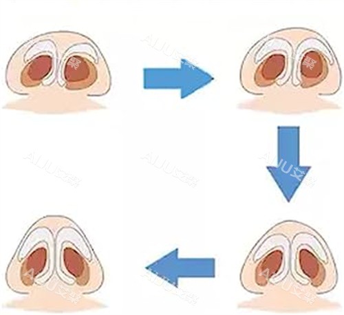 歪鼻