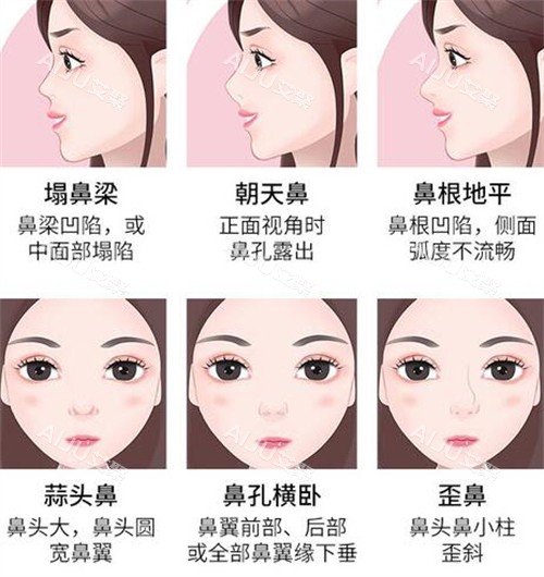 西安宿涛医生鼻子做得怎么样？技术细腻+审美自然+方案个性化，看看真实评价！