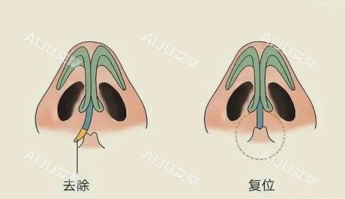 鼻子假体歪斜复位示意图