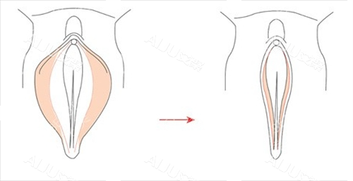 女性私密手术外阴动画展示