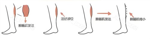 陈海深圳军科吸脂瘦大腿术后几天能下床？当天就能走！附修复阶段+护理全攻略~