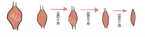 注射瘦腿肌肉缩小
