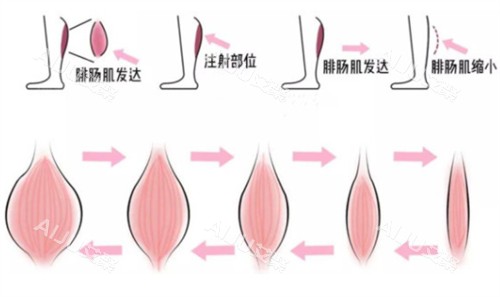 瘦腿注射前后对比