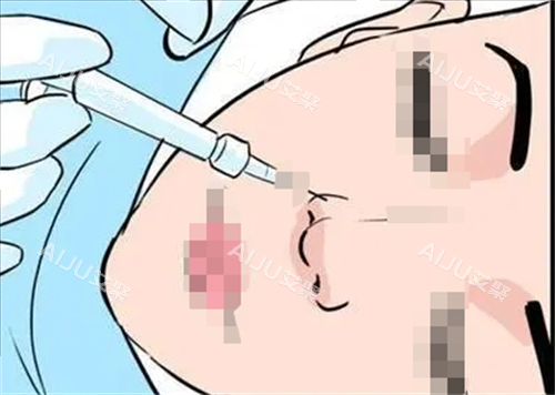 玻尿酸注射鼻子动画展示