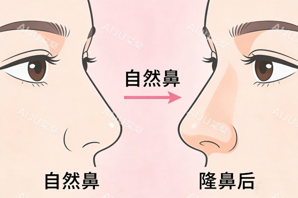 自然鼻型隆鼻前后对比图