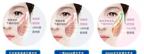 黄守寅面部提升怎么样？技术实力+审美理念+真人病例+价格区间+预约方式全解析！