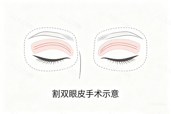 割双眼皮示意图