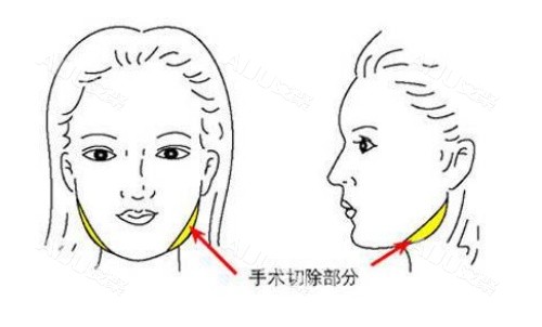 面部磨骨手术示意图