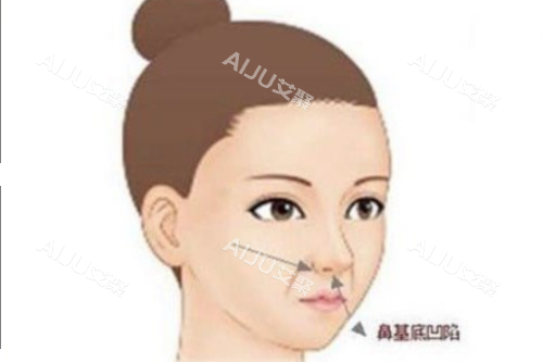 鼻基底凹陷