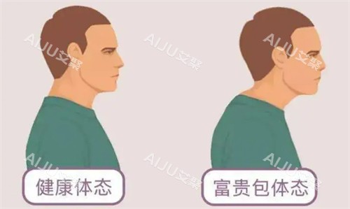 健康体态和富贵包体态对比