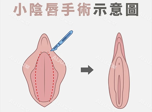 小阴唇整形前后对比 小阴唇整形前后对比
