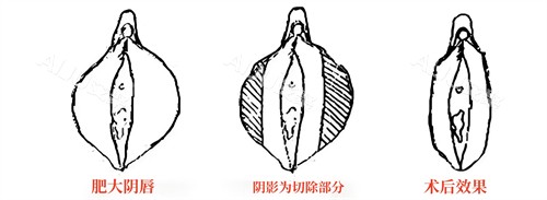 小阴唇肥大直接切除法演示动画图 小阴唇肥大直接切除法演示动画图