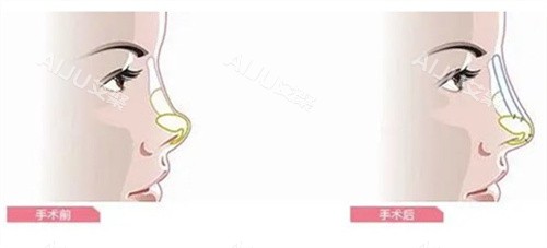 隆鼻手术前后对比