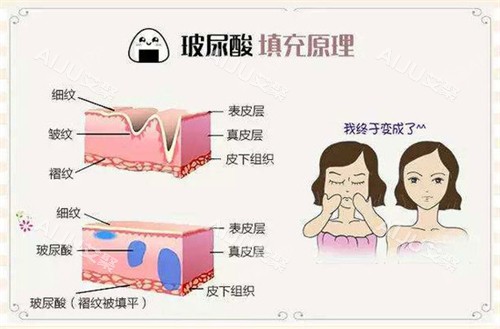 玻尿酸注射填充原理动画演示图
