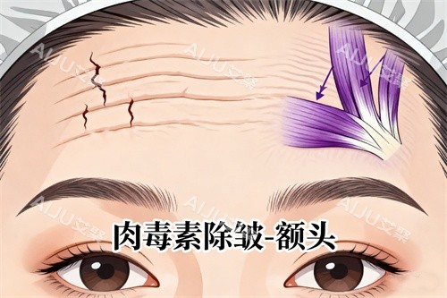 抬头纹注射卡通图