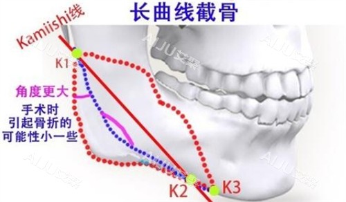 下颌角长曲线截骨的截骨位置