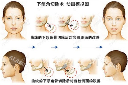 下颌角切除术动画模拟图