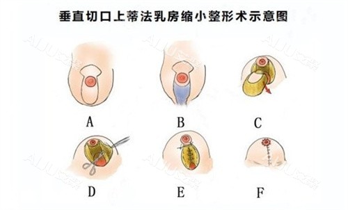 缩胸手术住院周期太长？唐欣医生的缩胸手术方案，如何做到术后即刻回家？