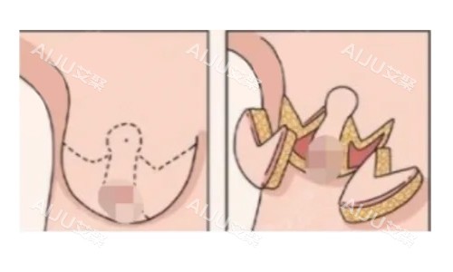 倒T法（标准乳房缩减术）展示