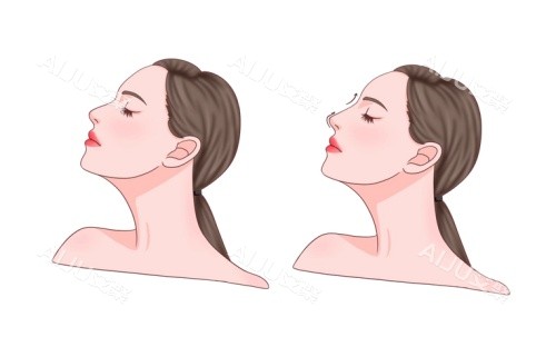 鼻整形术后示意图